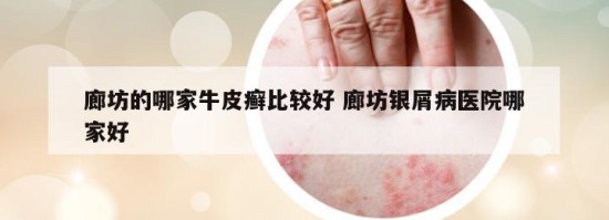 廊坊的哪家牛皮癣比较好 廊坊银屑病医院哪家好