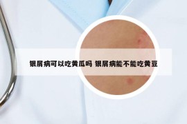 银屑病可以吃黄瓜吗 银屑病能不能吃黄豆