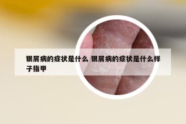 银屑病的症状是什么 银屑病的症状是什么样子指甲