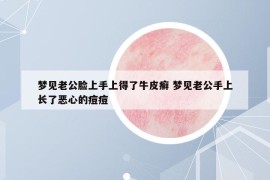 梦见老公脸上手上得了牛皮癣 梦见老公手上长了恶心的痘痘