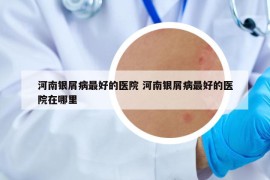 河南银屑病最好的医院 河南银屑病最好的医院在哪里