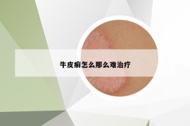 牛皮癣怎么那么难治疗