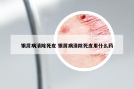 银屑病清除死皮 银屑病清除死皮用什么药