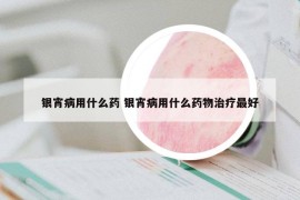 银宵病用什么药 银宵病用什么药物治疗最好