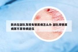 新兵在部队发现有银屑病怎么办 部队得银屑病算不算带病退伍