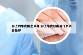 脚上的牛皮癣怎么办 脚上牛皮肤癣用什么药膏最好