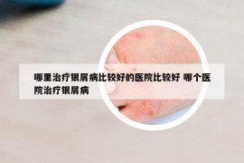 哪里治疗银屑病比较好的医院比较好 哪个医院治疗银屑病