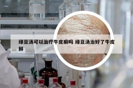 绿豆汤可以治疗牛皮癣吗 绿豆汤治好了牛皮鲜