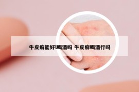 牛皮癣能好l喝酒吗 牛皮癣喝酒行吗