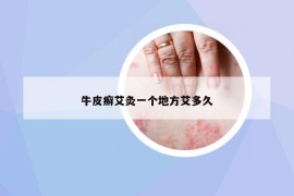 牛皮癣艾灸一个地方艾多久