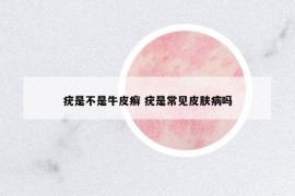 疣是不是牛皮癣 疣是常见皮肤病吗