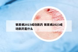 银屑病2023成功新药 银屑病2023成功新药是什么