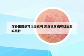 浑身银屑病可以治愈吗 浑身银屑病可以治愈吗男性