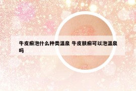 牛皮癣泡什么种类温泉 牛皮肤癣可以泡温泉吗