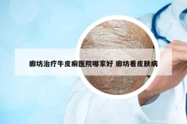 廊坊治疗牛皮癣医院哪家好 廊坊看皮肤病