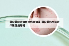 蒲公英能治银屑病吗金银花 蒲公英熬水洗治疗银屑病贴吧