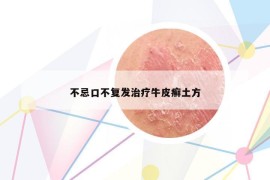 不忌口不复发治疗牛皮癣土方