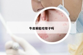 牛皮癣能吃柑子吗