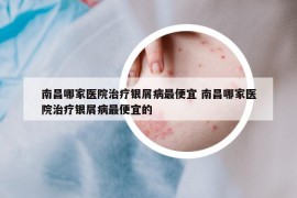 南昌哪家医院治疗银屑病最便宜 南昌哪家医院治疗银屑病最便宜的