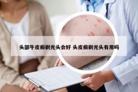 头部牛皮癣剃光头会好 头皮癣剃光头有用吗
