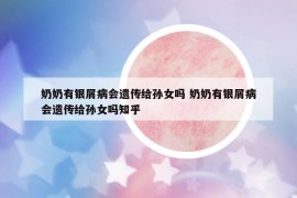 奶奶有银屑病会遗传给孙女吗 奶奶有银屑病会遗传给孙女吗知乎