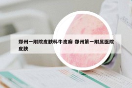 郑州一附院皮肤科牛皮癣 郑州第一附属医院皮肤
