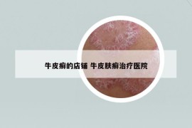 牛皮癣的店铺 牛皮肤癣治疗医院