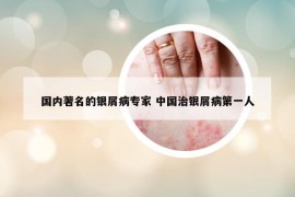 国内著名的银屑病专家 中国治银屑病第一人