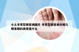 小儿寻常型银屑病图片 寻常型银屑病分哪几期各期的表现是什么
