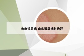 鲁南银屑病 山东银屑病包治好