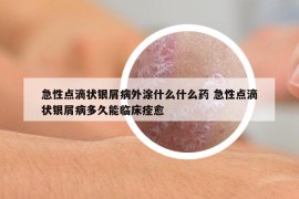 急性点滴状银屑病外涂什么什么药 急性点滴状银屑病多久能临床痊愈
