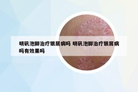 明矾泡脚治疗银屑病吗 明矾泡脚治疗银屑病吗有效果吗