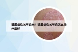 银屑病性关节炎MR 银屑病性关节炎怎么治疗最好