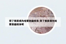 得了银屑病为啥要割扁桃体 得了银屑病为啥要割扁桃体呢