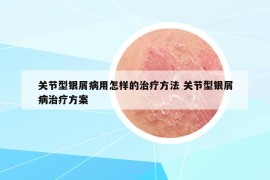 关节型银屑病用怎样的治疗方法 关节型银屑病治疗方案