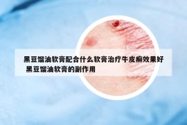 黑豆馏油软膏配合什么软膏治疗牛皮癣效果好 黑豆馏油软膏的副作用