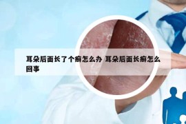 耳朵后面长了个癣怎么办 耳朵后面长癣怎么回事