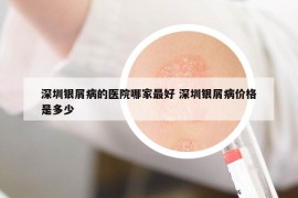 深圳银屑病的医院哪家最好 深圳银屑病价格是多少