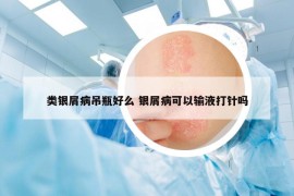 类银屑病吊瓶好么 银屑病可以输液打针吗