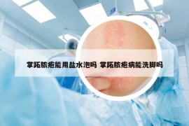掌跖脓疱能用盐水泡吗 掌跖脓疱病能洗脚吗