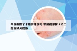 牛皮癣擦了卡铂会掉皮吗 银屑病涂抹卡泊三醇后鳞片脱落