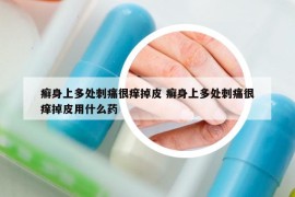癣身上多处刺痛很痒掉皮 癣身上多处刺痛很痒掉皮用什么药