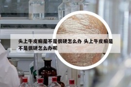 头上牛皮癣是不是很硬怎么办 头上牛皮癣是不是很硬怎么办呢