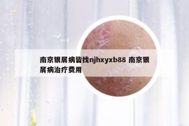 南京银屑病皆找njhxyxb88 南京银屑病治疗费用