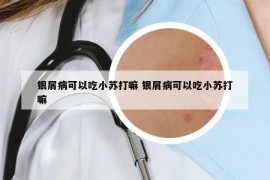 银屑病可以吃小苏打嘛 银屑病可以吃小苏打嘛