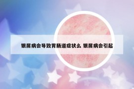 银屑病会导致胃肠道症状么 银屑病会引起
