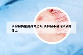 头癣会传染到身体上吗 头藓会不会传染到身体上
