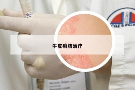 牛皮癣脐治疗