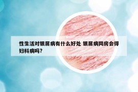 性生活对银屑病有什么好处 银屑病同房会得妇科病吗?