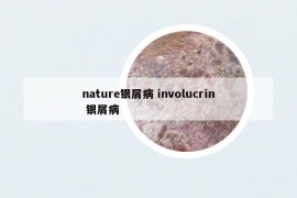 nature银屑病 involucrin 银屑病
